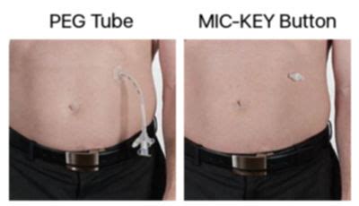 mickey tuber|mickey tube vs peg tube.